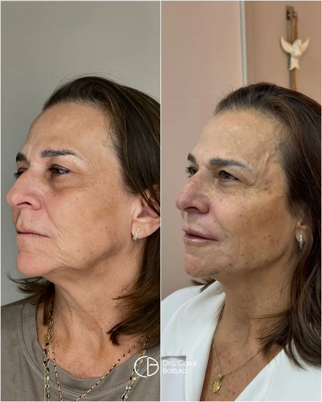 Antes e depois — Quero rejuvenescer meu rosto