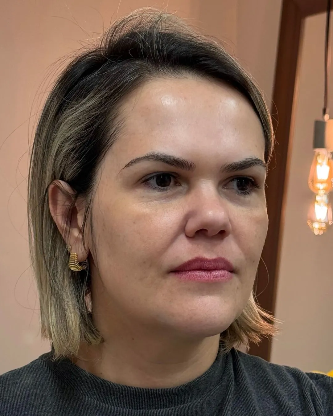 L., 38 anos — antes de Harmonização facial completa