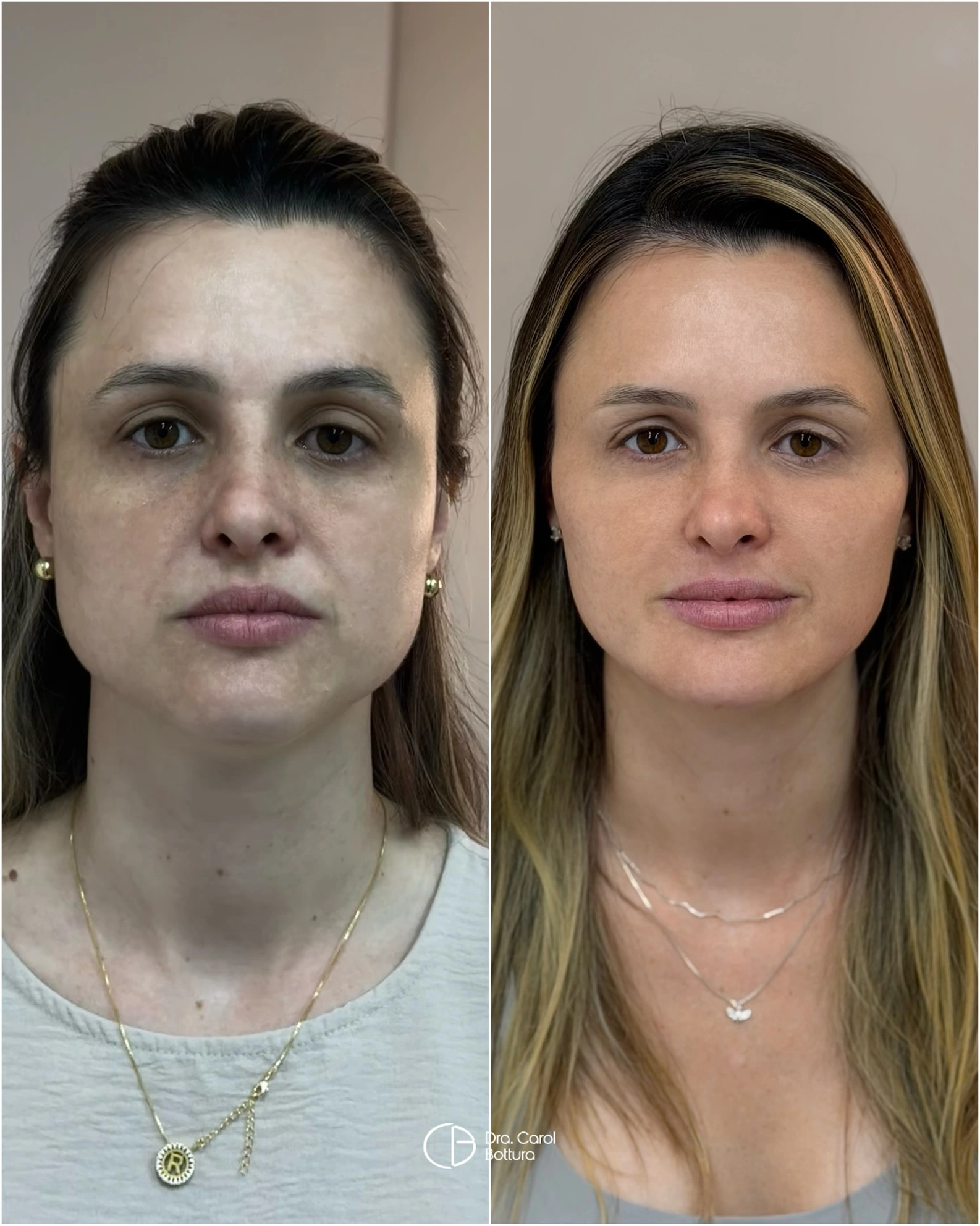 Antes e depois — Quero parecer menos cansada