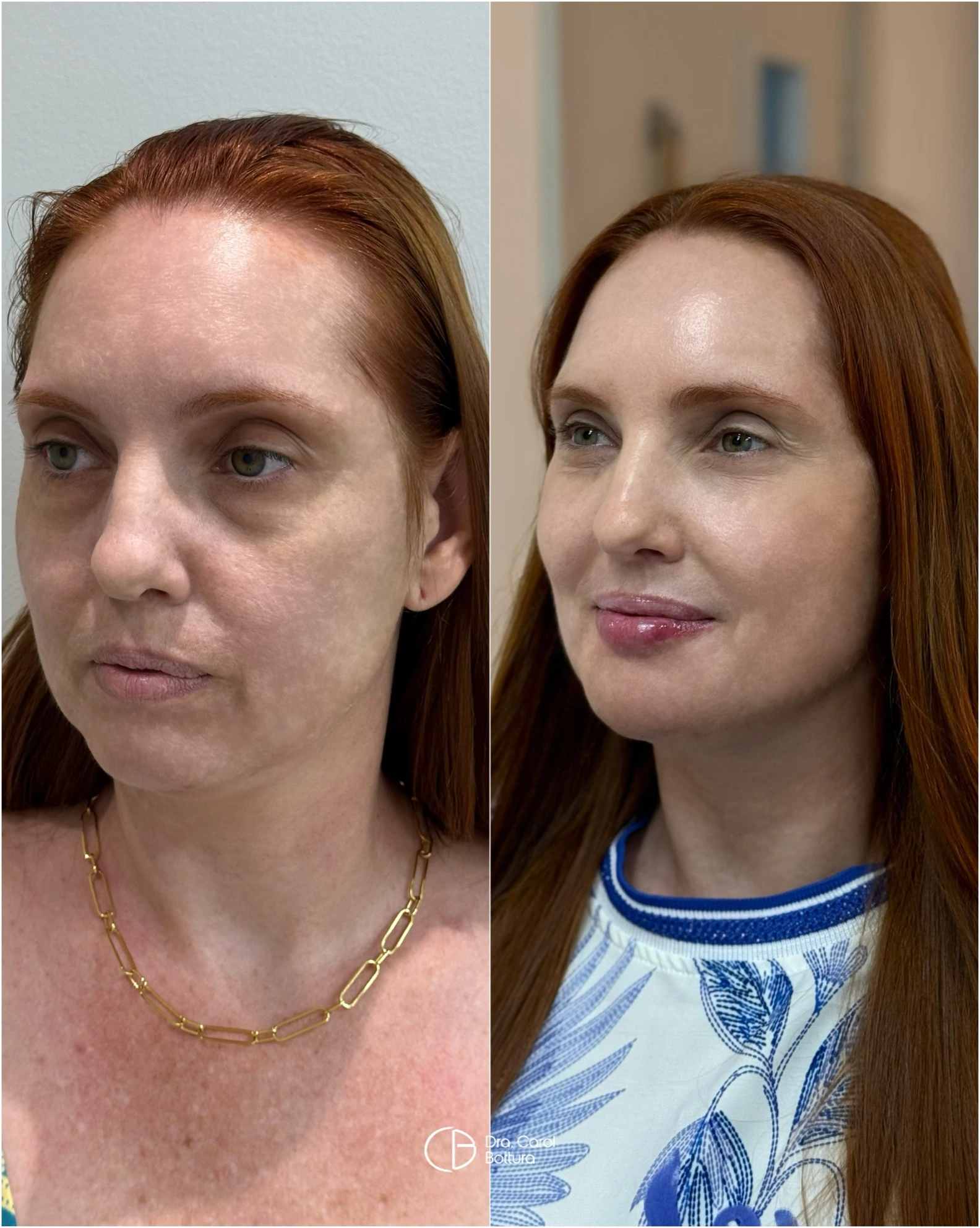 Antes e depois — Quero definir o meu contorno facial