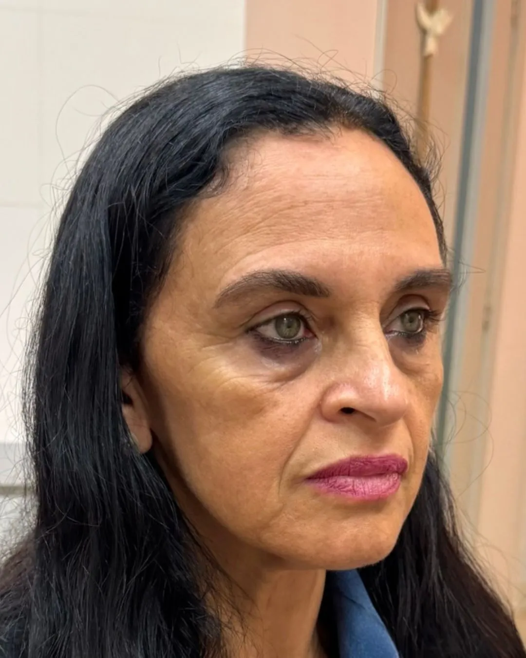 Ana C., 57 anos — antes de Botox + Full Face