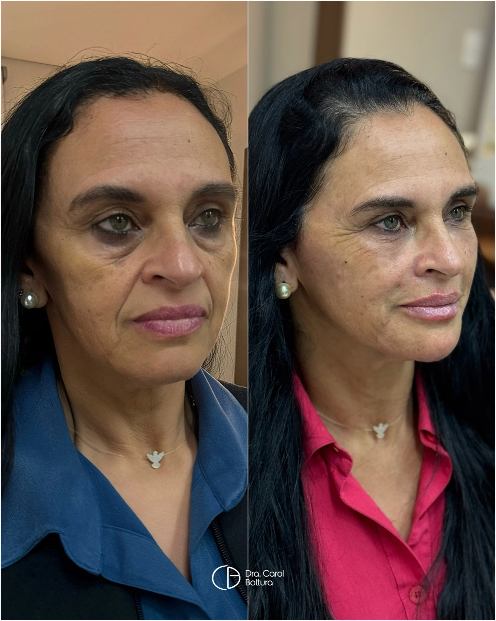 Antes e depois — Quero rejuvenescer meu rosto